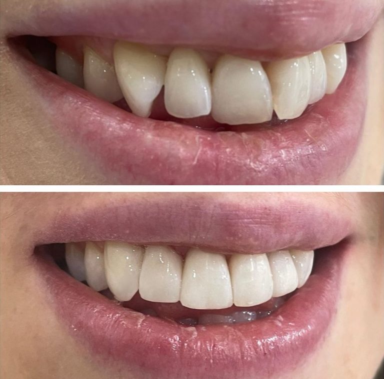 Composite Bonding: Crafting Invisible Solutions for Seamless Smiles